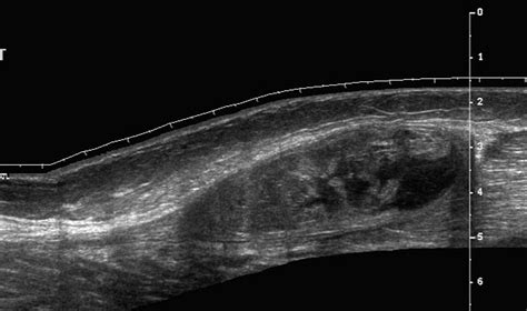 torn calf muscle ultrasound